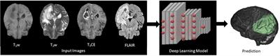 Using a generative adversarial network to generate synthetic MRI images for multi-class automatic segmentation of brain tumors